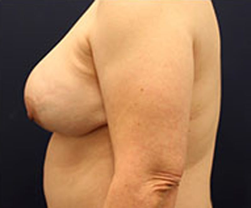 Breast Reconstruction Before & After Gallery - Patient 174160945 - Image 6