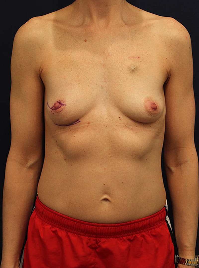 Breast Reconstruction Before & After Gallery - Patient 174160951 - Image 1