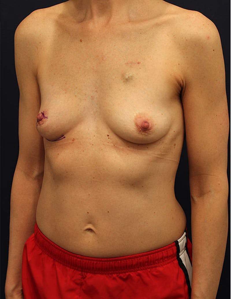 Breast Reconstruction Before & After Gallery - Patient 174160951 - Image 3
