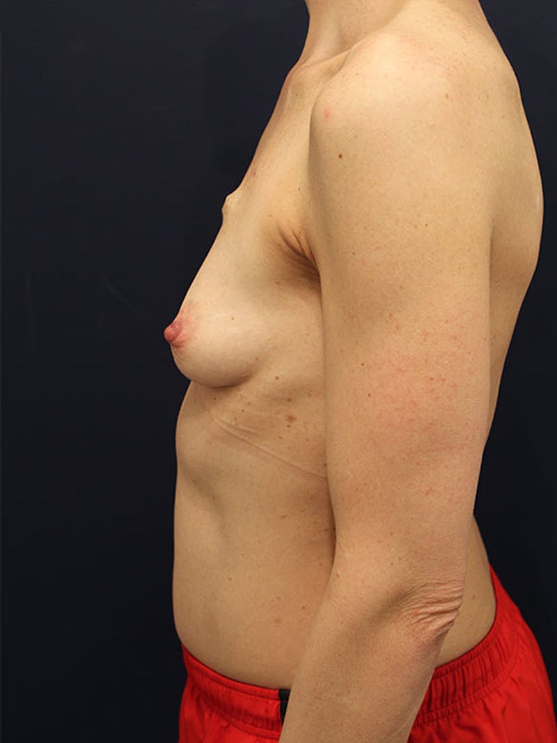 Breast Reconstruction Before & After Gallery - Patient 174160951 - Image 5