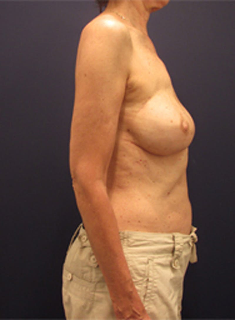 Breast Reconstruction Before & After Gallery - Patient 174160957 - Image 6