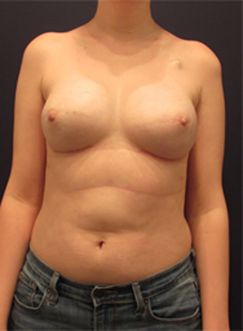 Breast Reconstruction Before & After Gallery - Patient 174160963 - Image 2