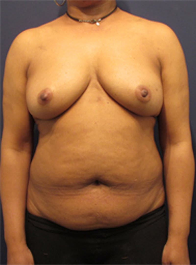 Breast Reconstruction Before & After Gallery - Patient 174160969 - Image 1