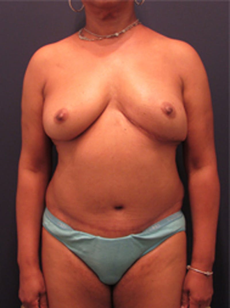Breast Reconstruction Before & After Gallery - Patient 174160969 - Image 2