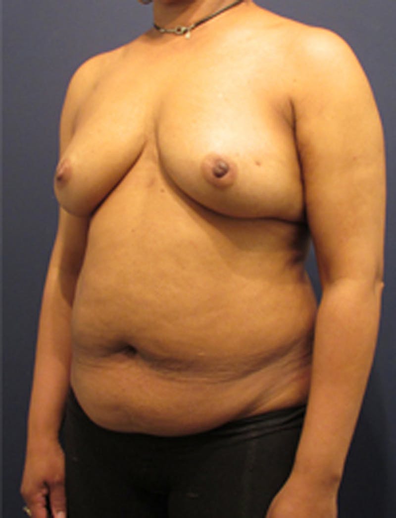 Breast Reconstruction Before & After Gallery - Patient 174160969 - Image 3