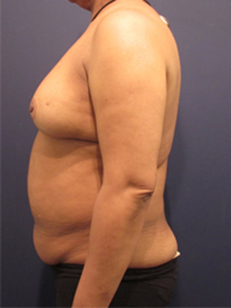 Breast Reconstruction Before & After Gallery - Patient 174160969 - Image 5