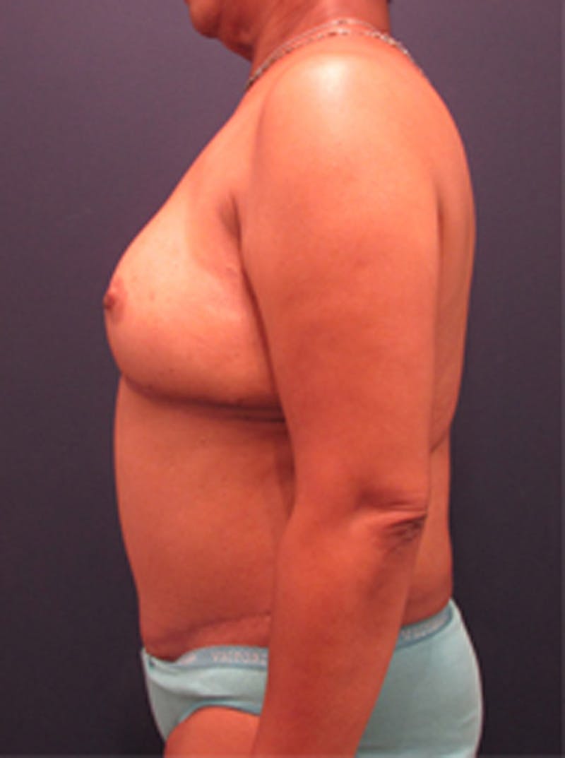 Breast Reconstruction Before & After Gallery - Patient 174160969 - Image 6