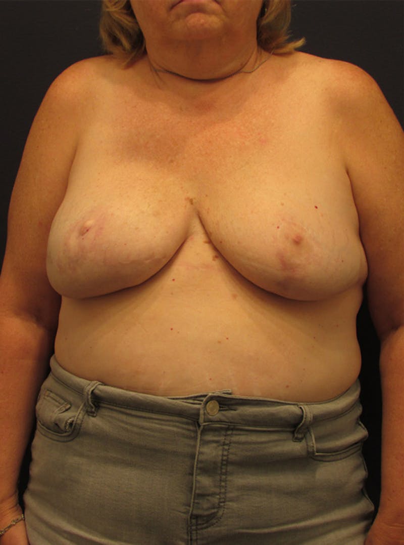 Breast Reconstruction Before & After Gallery - Patient 174162051 - Image 2