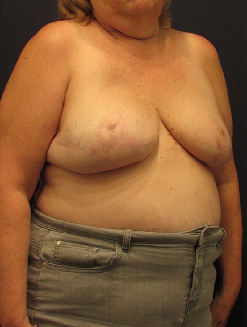 Breast Reconstruction Before & After Gallery - Patient 174162051 - Image 4