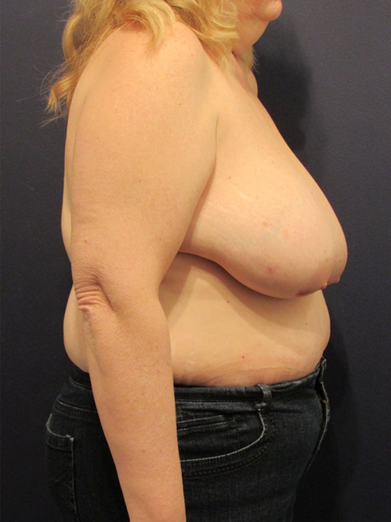 Breast Reconstruction Before & After Gallery - Patient 174162051 - Image 5
