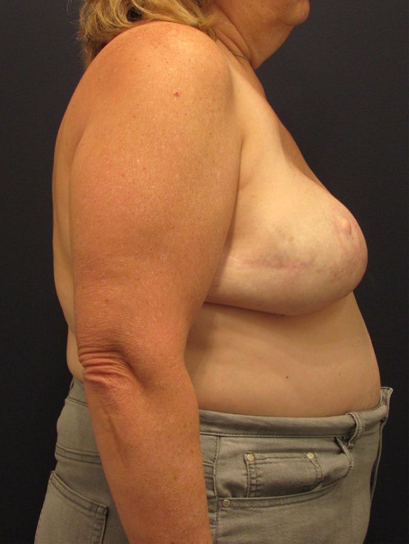 Breast Reconstruction Before & After Gallery - Patient 174162051 - Image 6