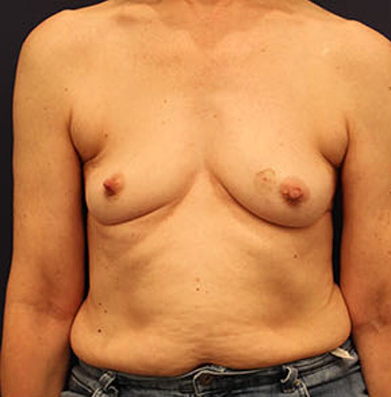 Breast Reconstruction Before & After Gallery - Patient 174162056 - Image 1