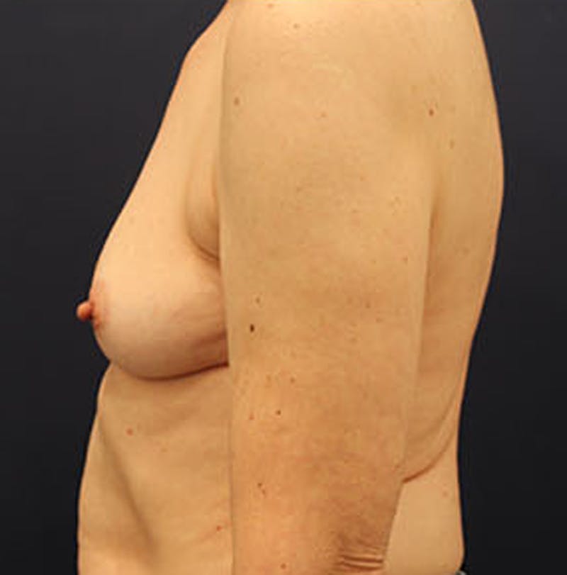 Breast Reconstruction Before & After Gallery - Patient 174162056 - Image 3