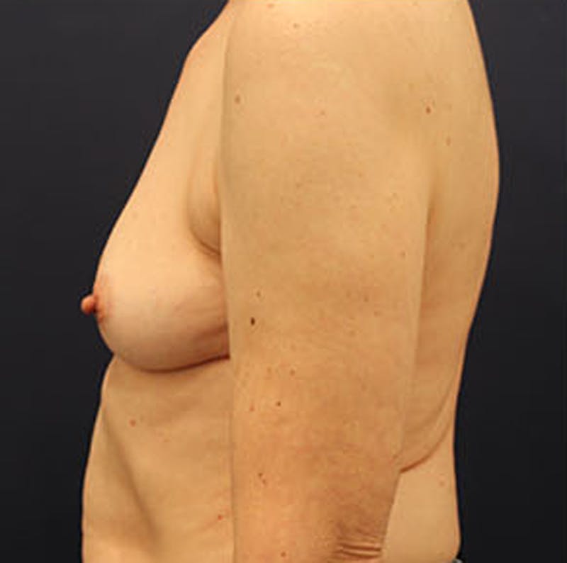 Breast Reconstruction Before & After Gallery - Patient 174162056 - Image 5