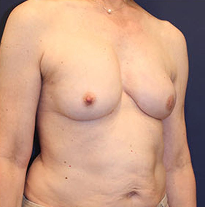 Breast Reconstruction Before & After Gallery - Patient 174162056 - Image 8