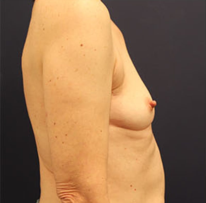 Breast Reconstruction Before & After Gallery - Patient 174162056 - Image 9