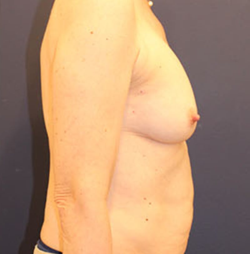 Breast Reconstruction Before & After Gallery - Patient 174162056 - Image 10