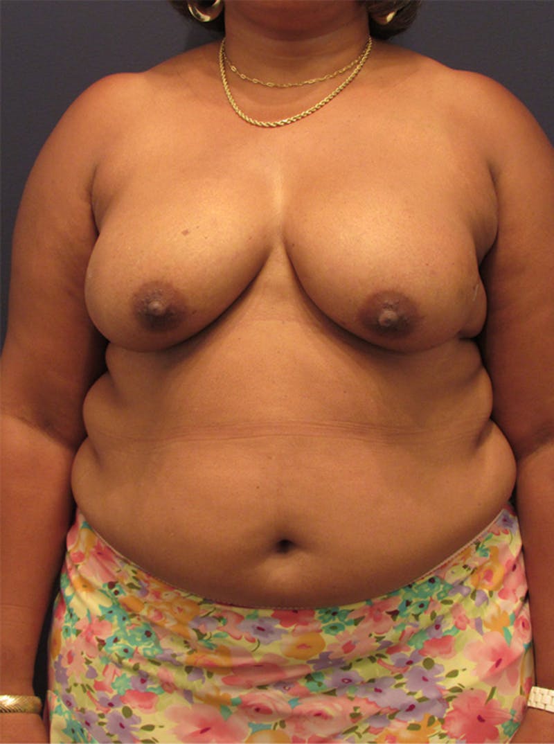Breast Reconstruction Before & After Gallery - Patient 174162068 - Image 1