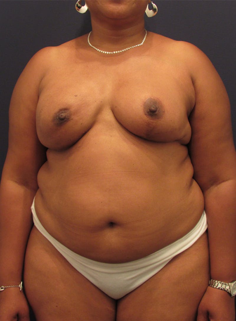 Breast Reconstruction Before & After Gallery - Patient 174162068 - Image 2