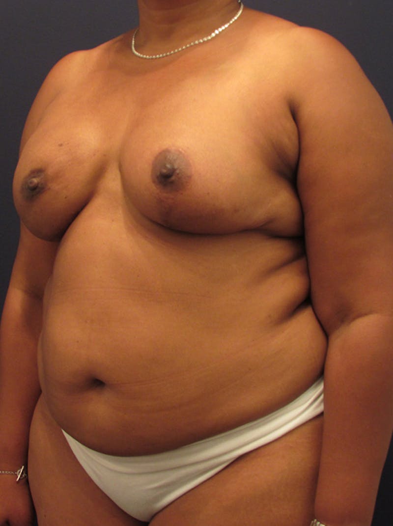 Breast Reconstruction Before & After Gallery - Patient 174162068 - Image 4