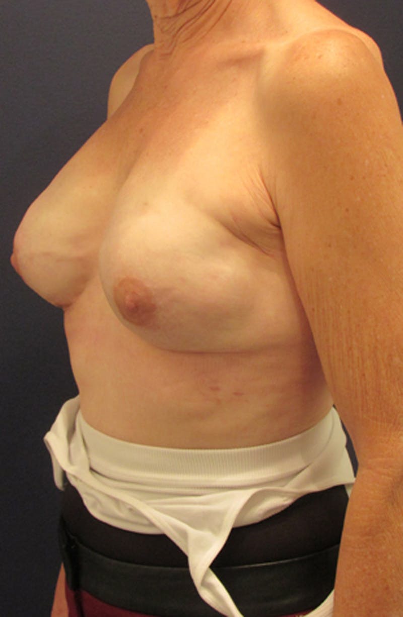 Breast Reconstruction Before & After Gallery - Patient 174163163 - Image 4