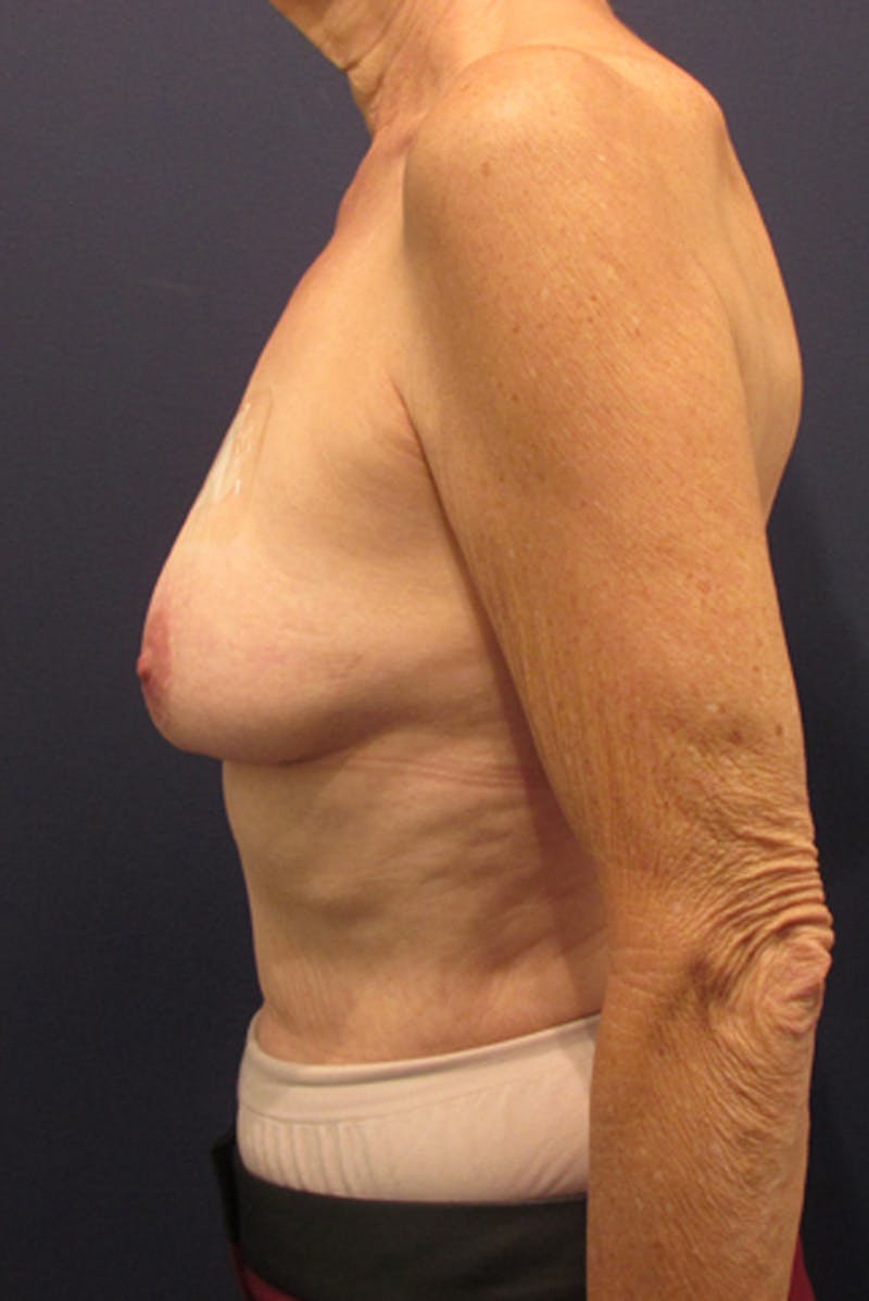 Breast Reconstruction Before & After Gallery - Patient 174163163 - Image 5