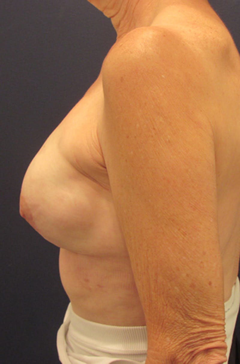 Breast Reconstruction Before & After Gallery - Patient 174163163 - Image 6