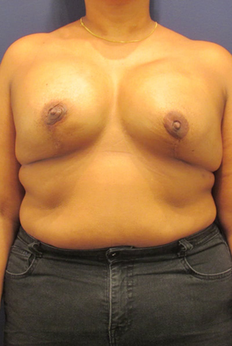 Breast Reconstruction Before & After Gallery - Patient 174163172 - Image 2