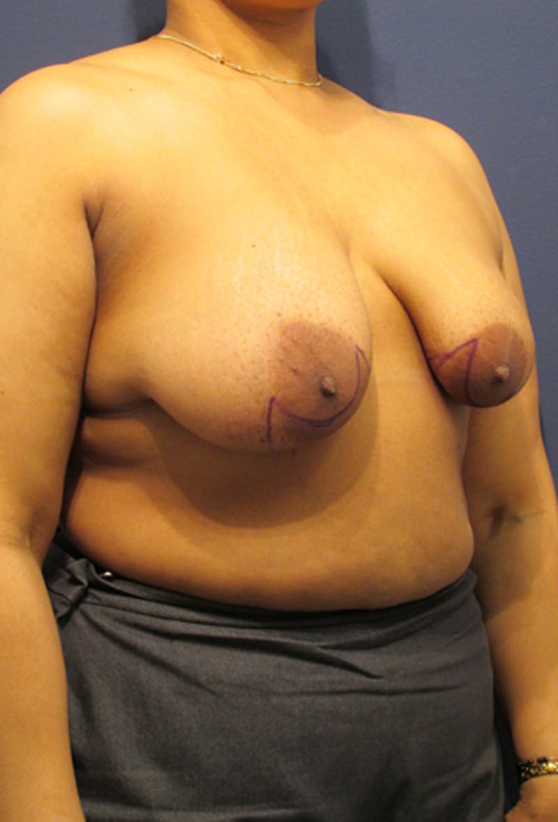 Breast Reconstruction Before & After Gallery - Patient 174163172 - Image 3