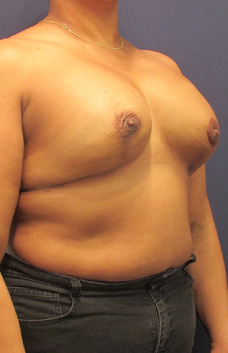 Breast Reconstruction Before & After Gallery - Patient 174163172 - Image 4