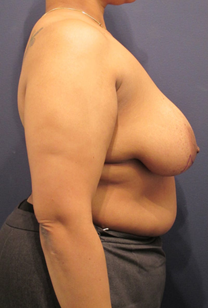 Breast Reconstruction Before & After Gallery - Patient 174163172 - Image 5