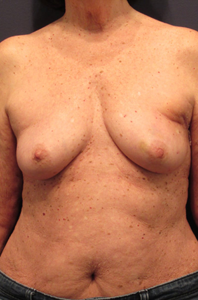 Breast Reconstruction Before & After Gallery - Patient 174163183 - Image 1