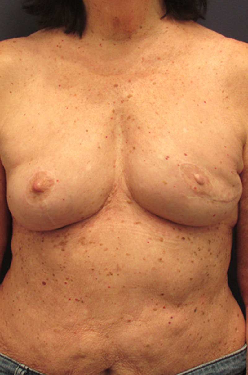 Breast Reconstruction Before & After Gallery - Patient 174163183 - Image 2