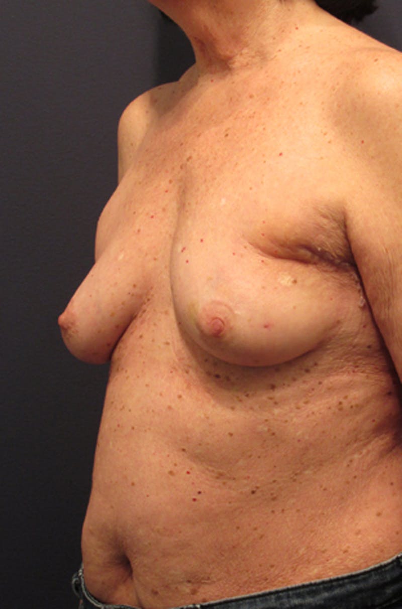 Breast Reconstruction Before & After Gallery - Patient 174163183 - Image 3