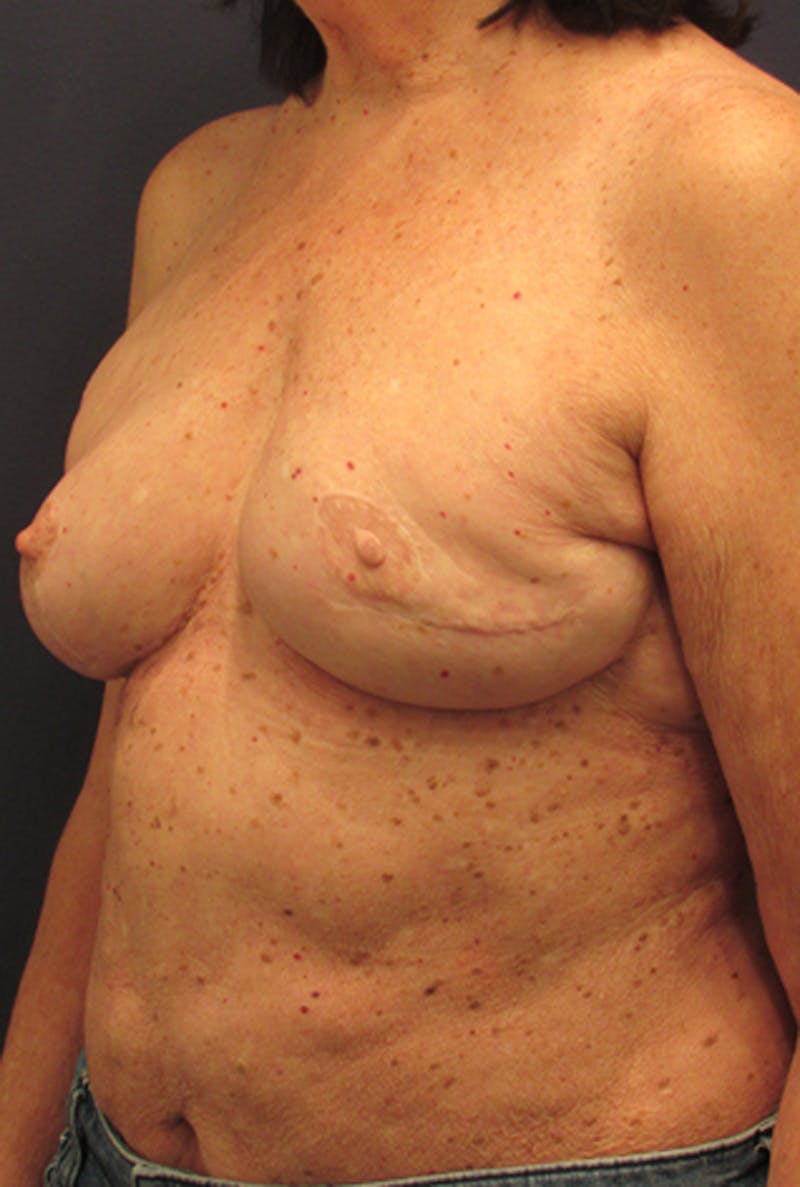 Breast Reconstruction Before & After Gallery - Patient 174163183 - Image 4