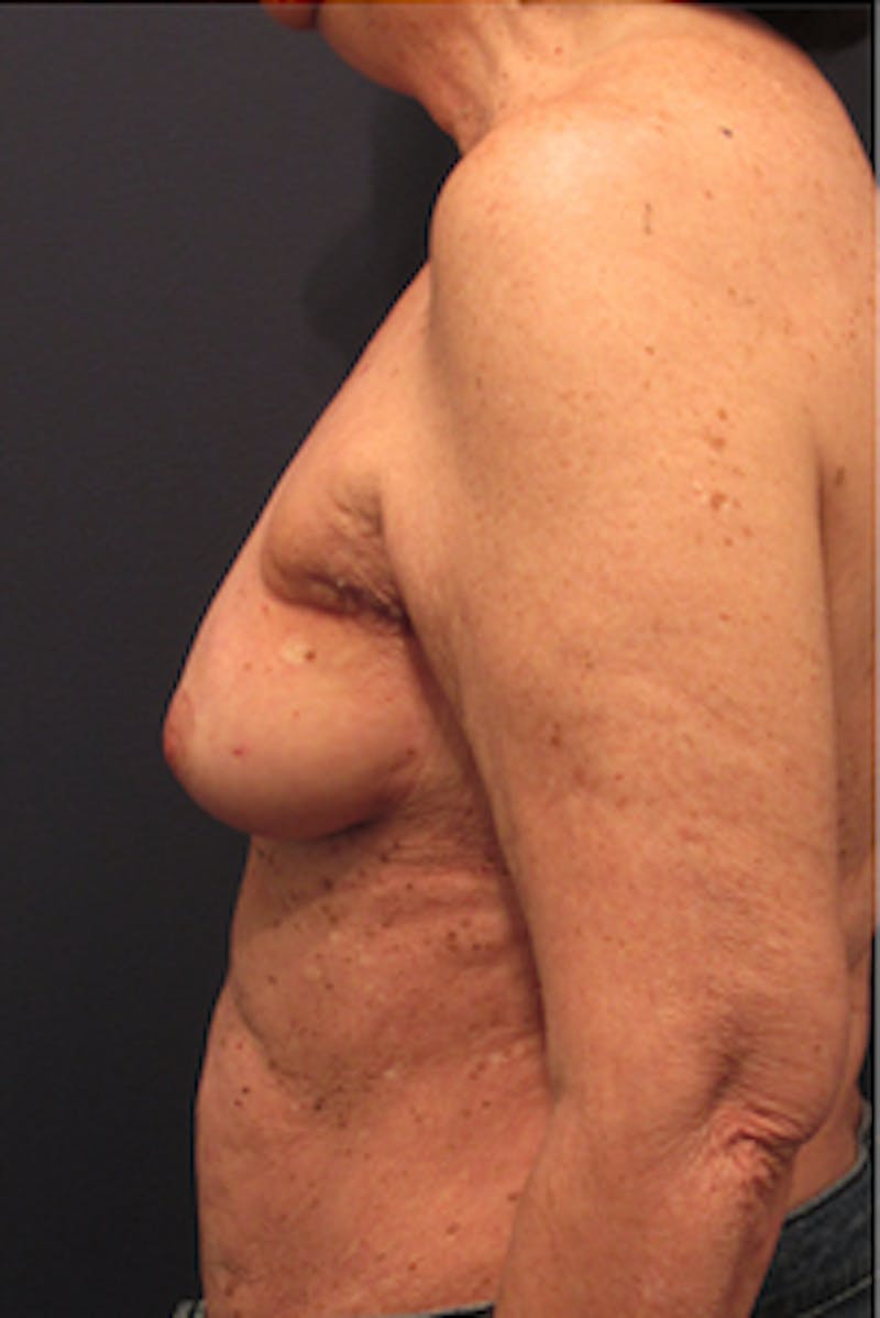 Breast Reconstruction Before & After Gallery - Patient 174163183 - Image 5