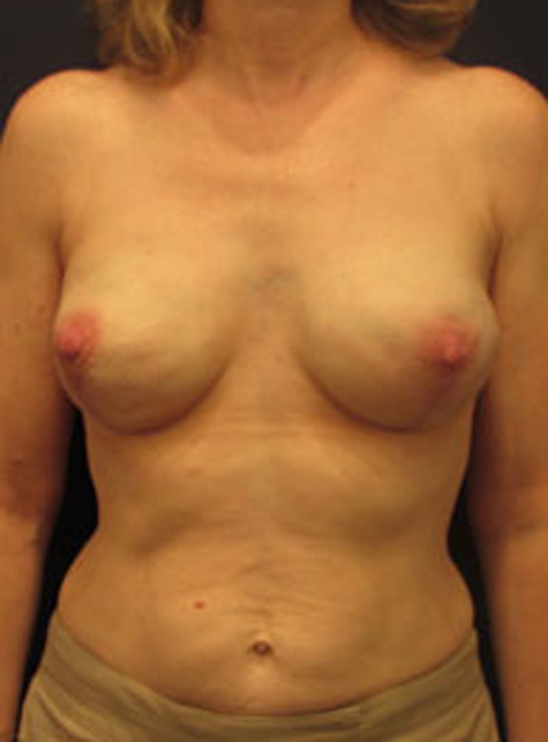 Breast Reconstruction Before & After Gallery - Patient 174163189 - Image 2