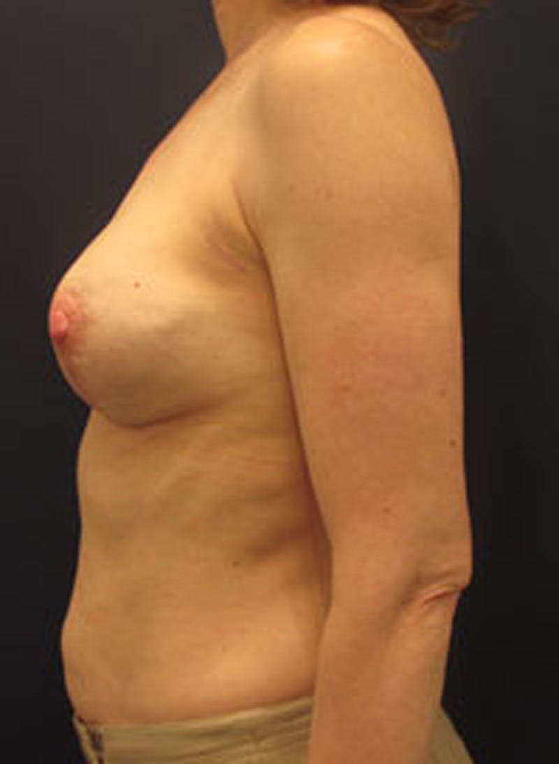 Breast Reconstruction Before & After Gallery - Patient 174163189 - Image 4