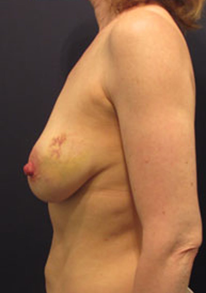 Breast Reconstruction Before & After Gallery - Patient 174163189 - Image 5