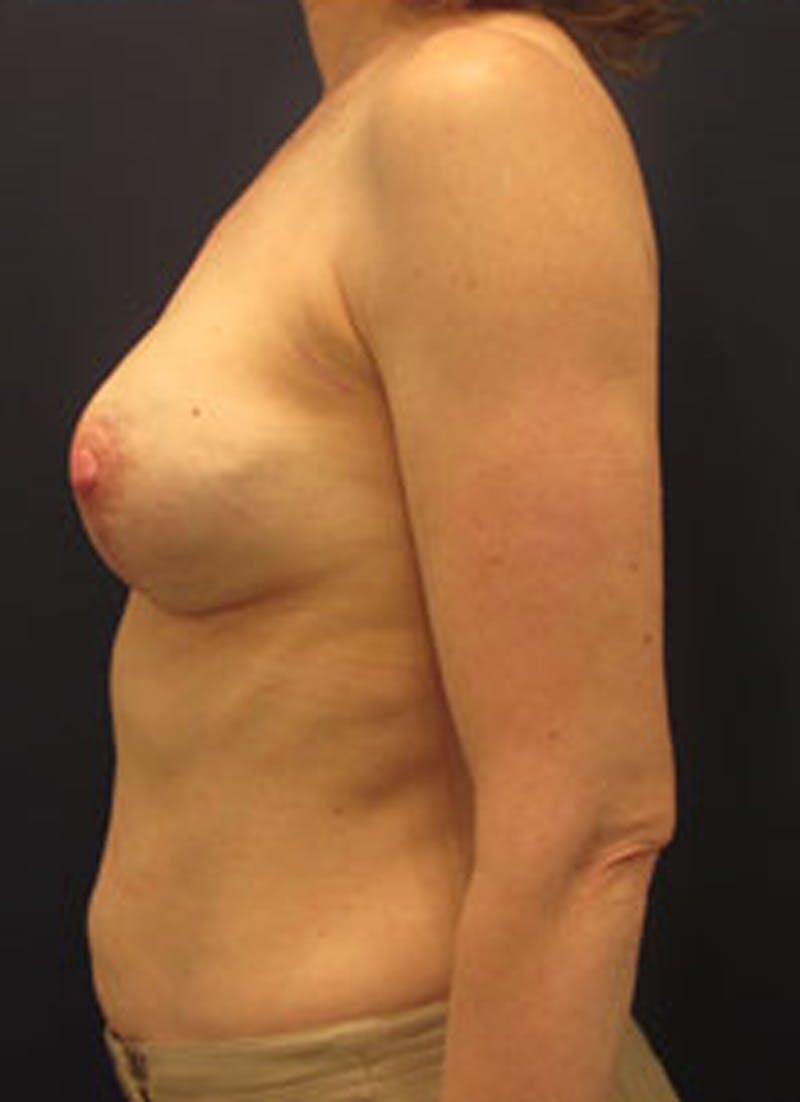 Breast Reconstruction Before & After Gallery - Patient 174163189 - Image 6