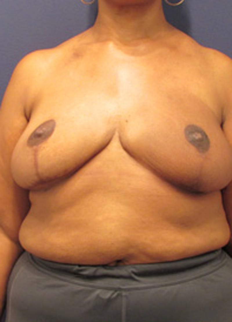 Breast Reconstruction Before & After Gallery - Patient 174163192 - Image 2