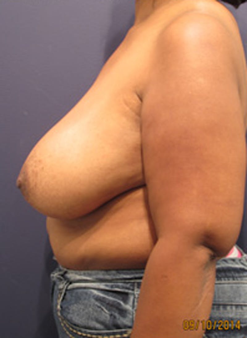 Breast Reconstruction Before & After Gallery - Patient 174163192 - Image 3