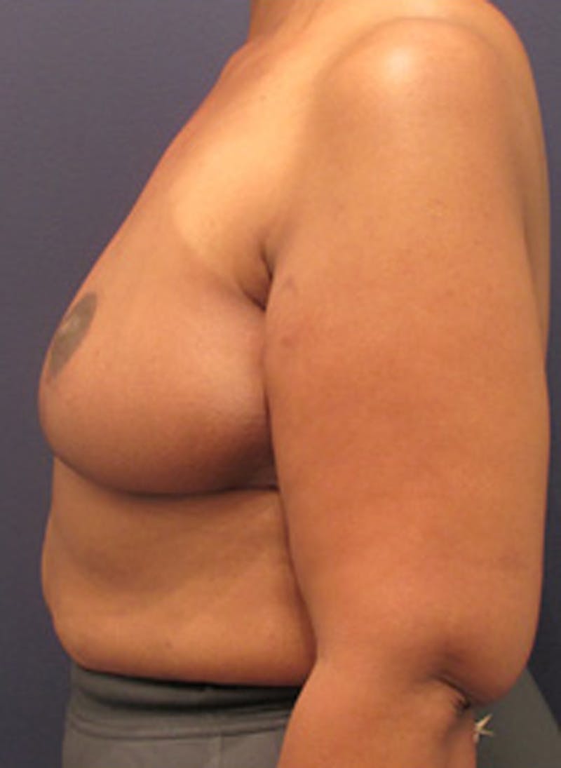 Breast Reconstruction Before & After Gallery - Patient 174163192 - Image 4