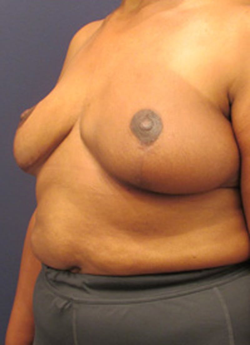 Breast Reconstruction Before & After Gallery - Patient 174163192 - Image 6
