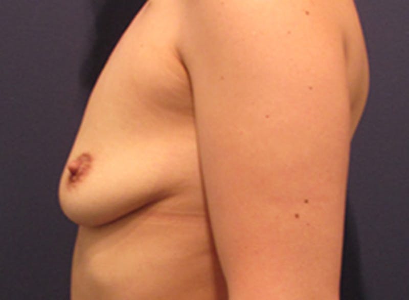 Breast Reconstruction Before & After Gallery - Patient 174163201 - Image 3