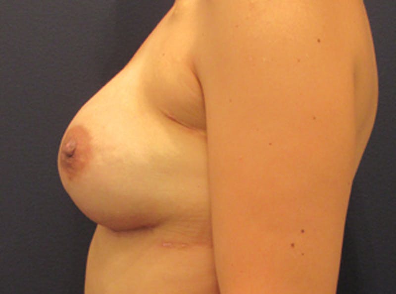 Breast Reconstruction Before & After Gallery - Patient 174163201 - Image 4