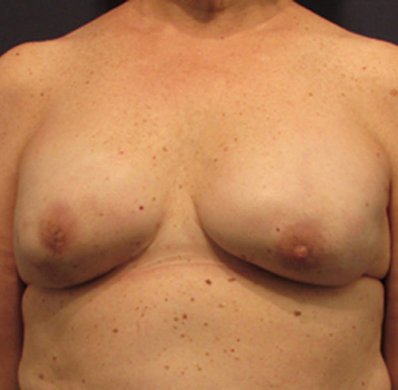 Breast Reconstruction Before & After Gallery - Patient 174163214 - Image 2
