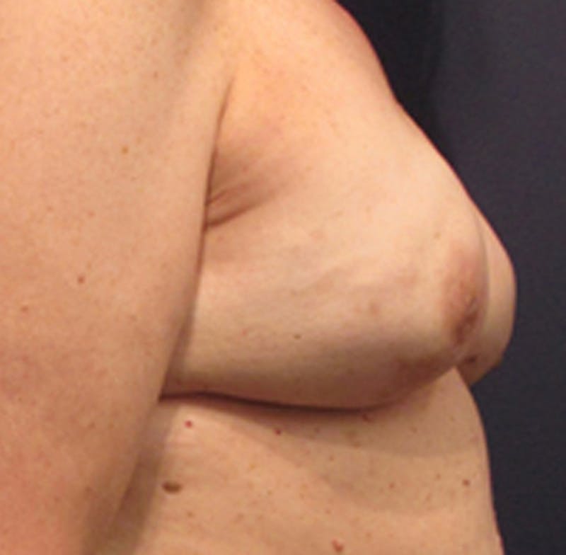 Breast Reconstruction Before & After Gallery - Patient 174163214 - Image 4