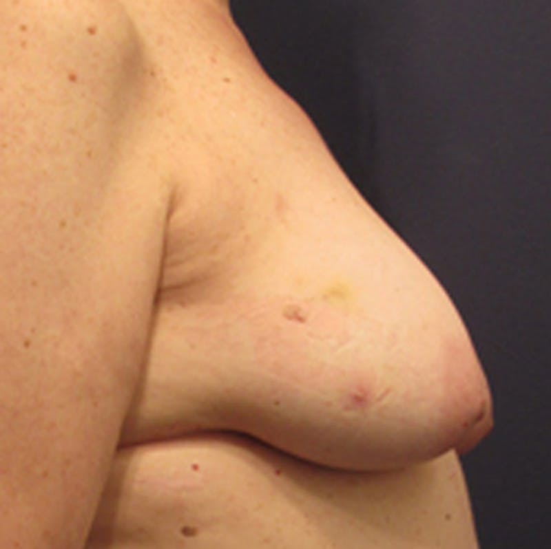 Breast Reconstruction Before & After Gallery - Patient 174163214 - Image 5