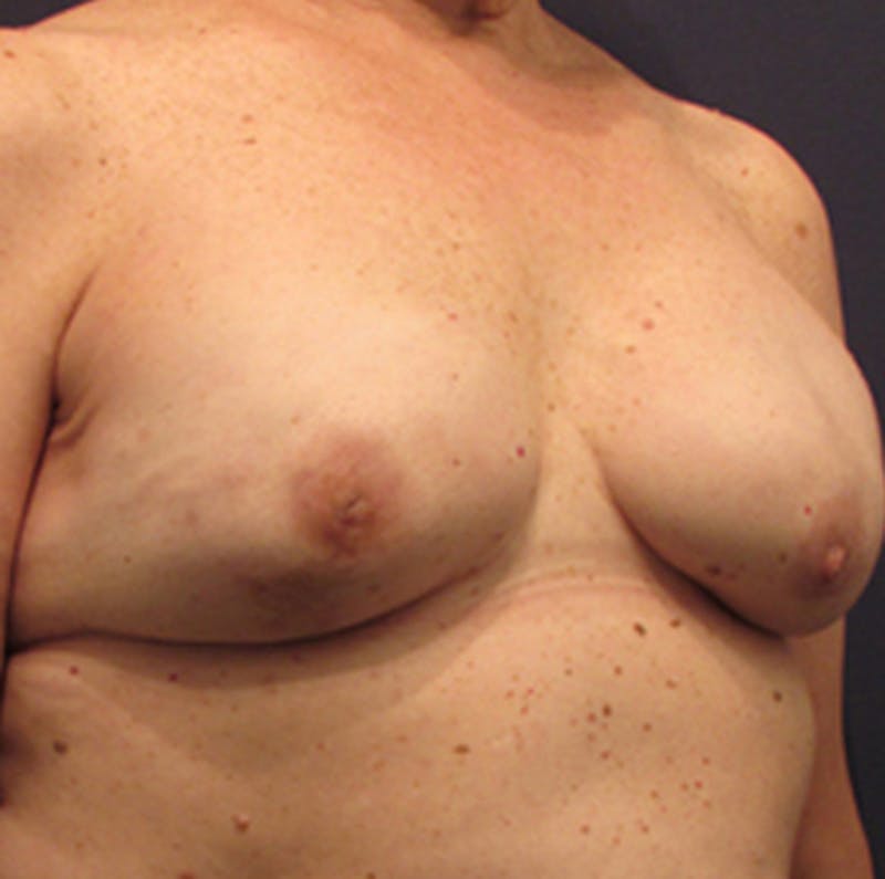 Breast Reconstruction Before & After Gallery - Patient 174163214 - Image 6